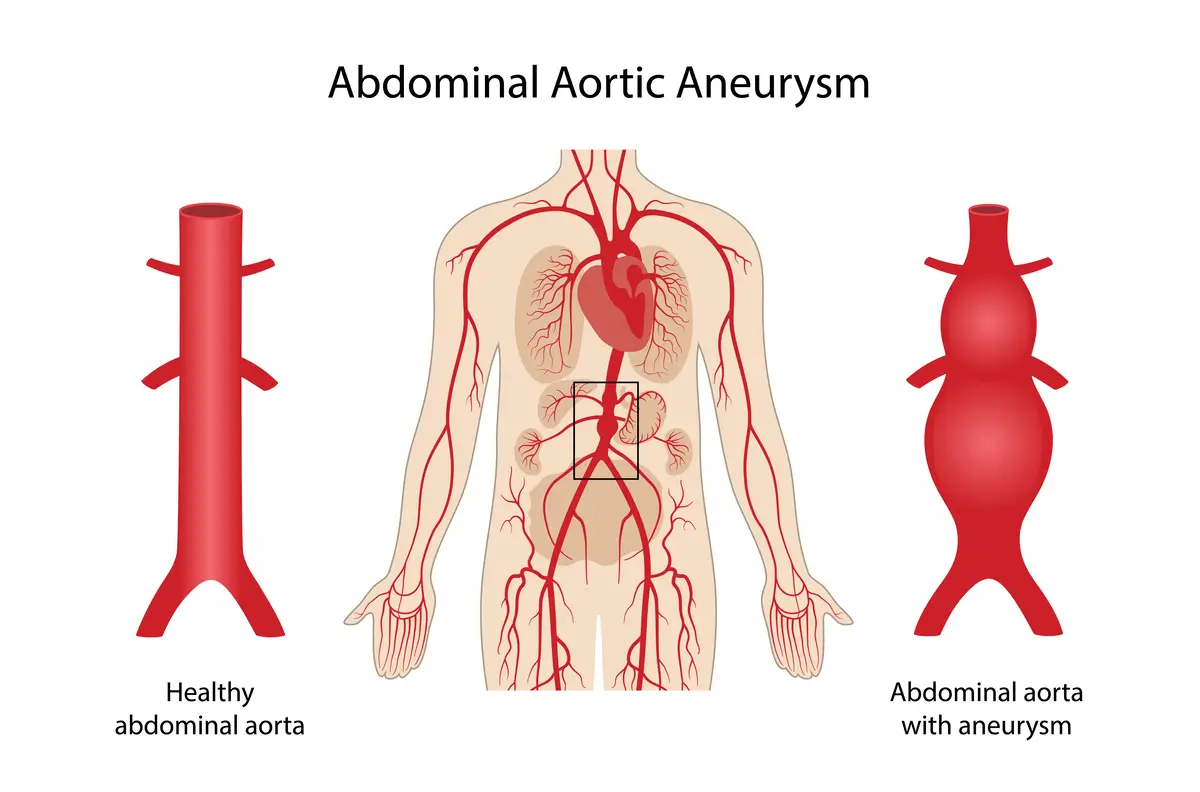 Types of Aortic Disease - Abdominal Aortic Aneurysm (AAA) | https://www.harleystreet.sg/